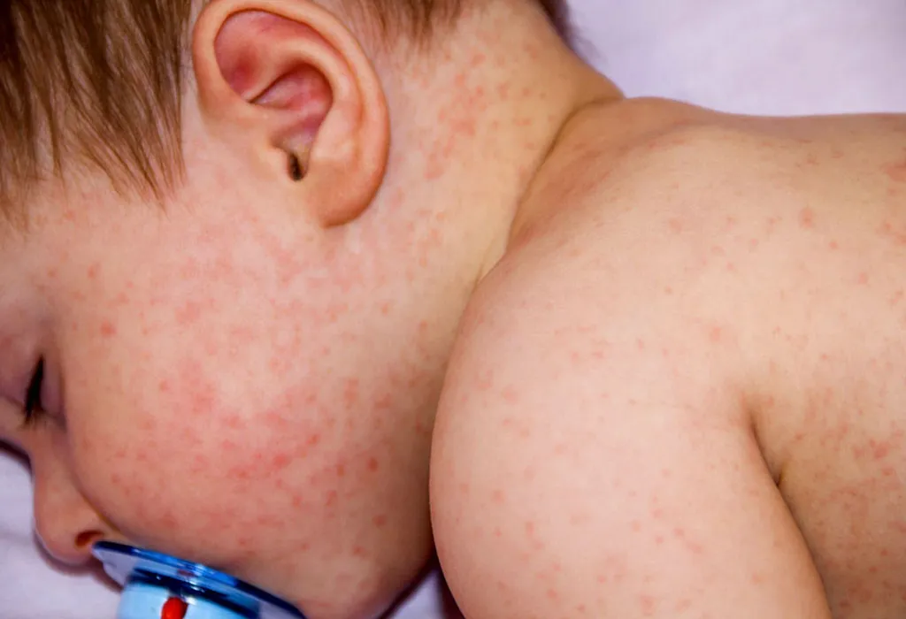 The 7 Most Common Baby Allergies